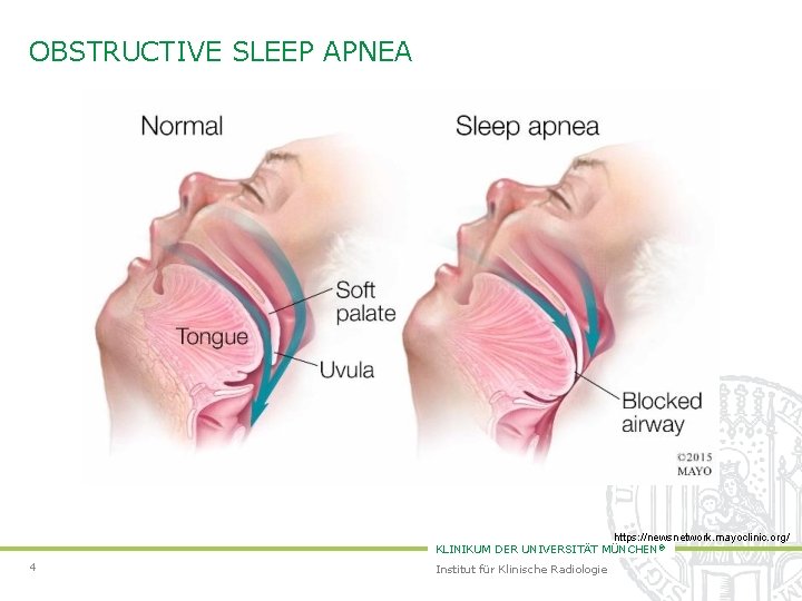 OBSTRUCTIVE SLEEP APNEA https: //newsnetwork. mayoclinic. org/ KLINIKUM DER UNIVERSITÄT MÜNCHEN ® 4 Institut