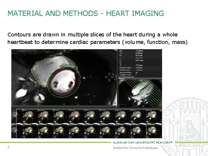 MATERIAL AND METHODS - HEART IMAGING Contours are drawn in multiple slices of the