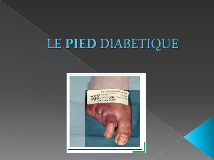 LE PIED DIABETIQUE 