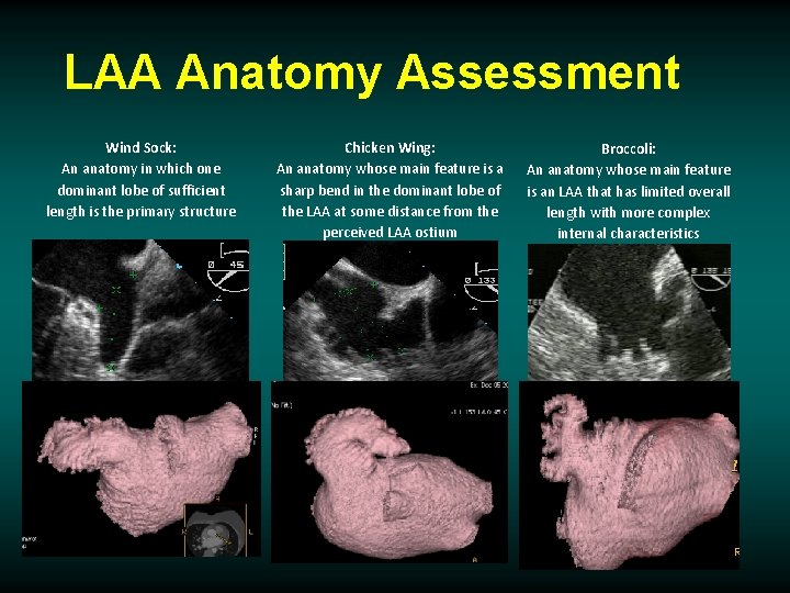 LAA Anatomy Assessment Wind Sock: An anatomy in which one dominant lobe of sufficient