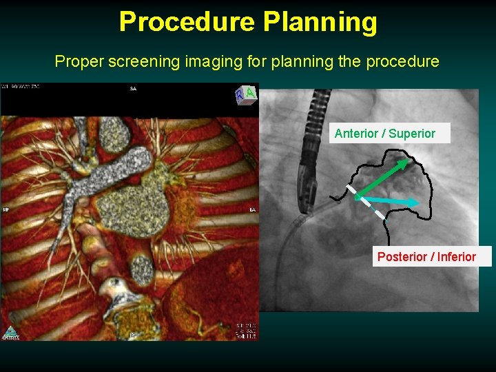 Procedure Planning Proper screening imaging for planning the procedure Anterior / Superior Posterior /