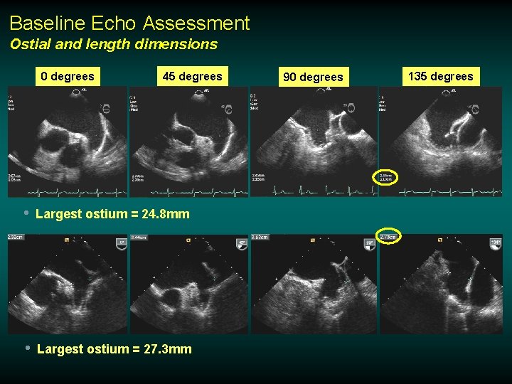 Baseline Echo Assessment Ostial and length dimensions 0 degrees 45 degrees • Largest ostium