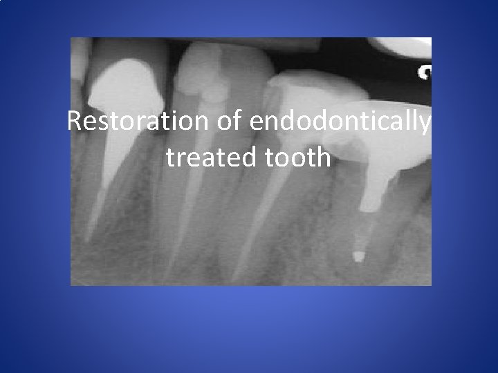 Restoration of endodontically treated tooth 