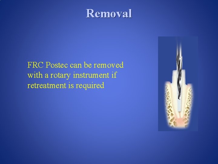 Removal FRC Postec can be removed with a rotary instrument if retreatment is required