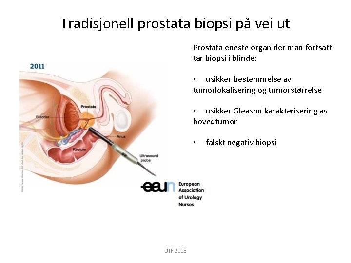 Tradisjonell prostata biopsi på vei ut Prostata eneste organ der man fortsatt tar biopsi
