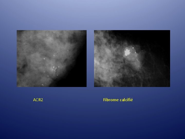 ACR 2 Fibrome calcifié ACR 2 Fibrome calcifié