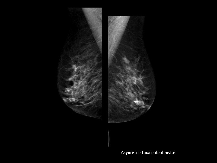 Asymétrie focale de densité Asymétrie focale de densité