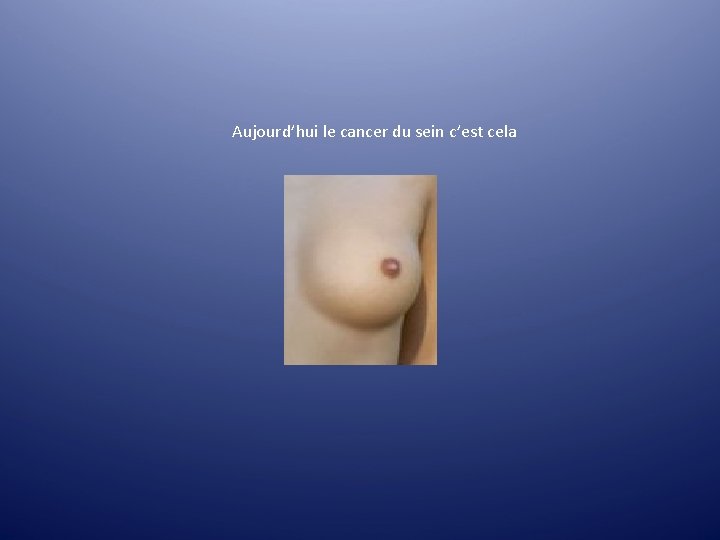 Aujourd’hui le cancer du sein c’est cela Aujourd’hui le cancer du sein c’est cela