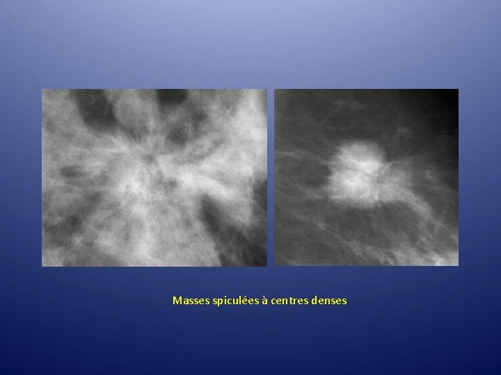 Masses spiculées à centres denses Masses spiculées à centres denses