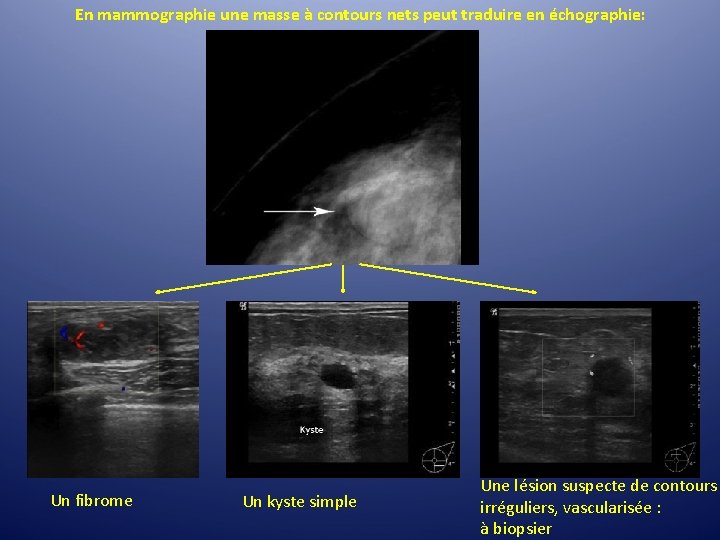 En mammographie une masse à contours nets peut traduire en échographie: Un fibrome Un En mammographie une masse à contours nets peut traduire en échographie: Un fibrome Un