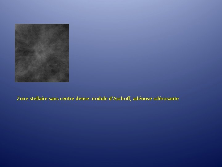 Zone stellaire sans centre dense: nodule d’Aschoff, adénose sclérosante Zone stellaire sans centre dense: nodule d’Aschoff, adénose sclérosante