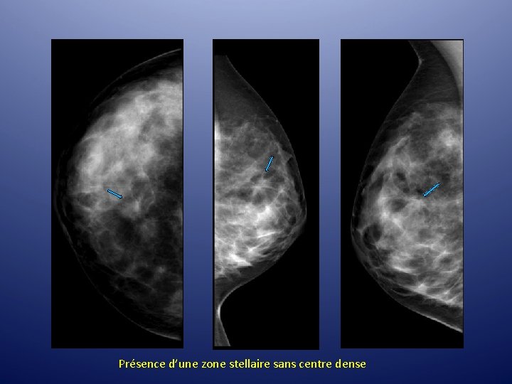 Présence d’une zone stellaire sans centre dense Présence d’une zone stellaire sans centre dense