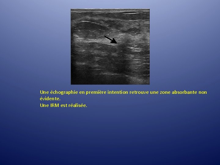 Une échographie en première intention retrouve une zone absorbante non évidente. Une IRM est Une échographie en première intention retrouve une zone absorbante non évidente. Une IRM est