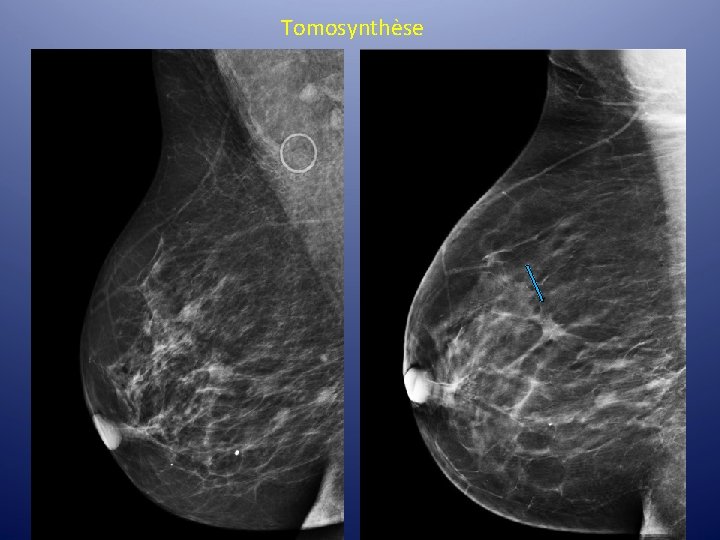 Tomosynthèse Tomosynthèse