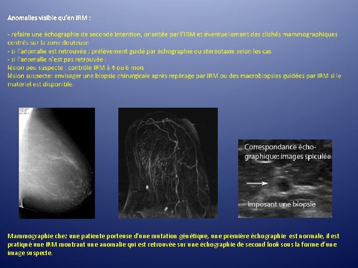 Mammographie chez une patiente porteuse d’une mutation génétique, une première échographie est normale, il Mammographie chez une patiente porteuse d’une mutation génétique, une première échographie est normale, il
