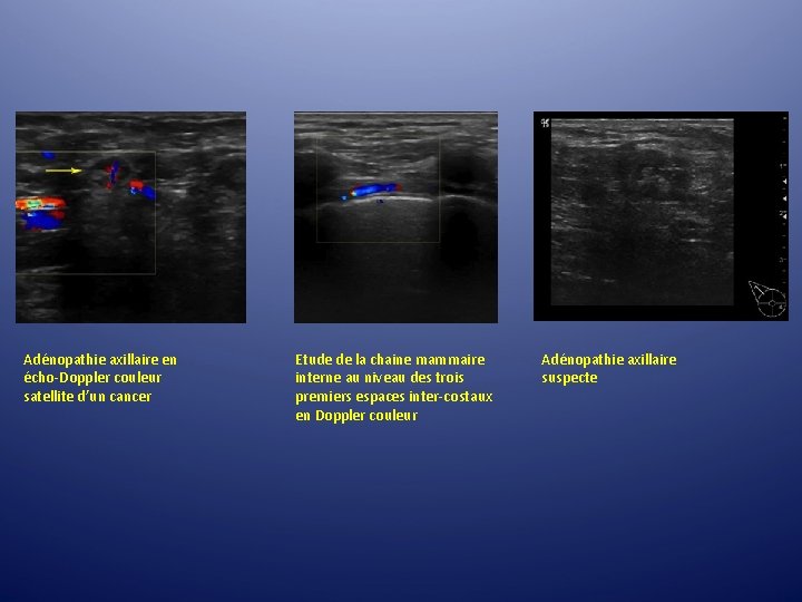 Adénopathie axillaire en écho-Doppler couleur satellite d’un cancer Etude de la chaine mammaire interne Adénopathie axillaire en écho-Doppler couleur satellite d’un cancer Etude de la chaine mammaire interne