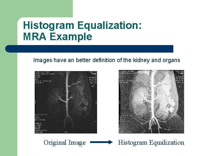 Histogram Equalization: MRA Example Images have an better definition of the kidney and organs