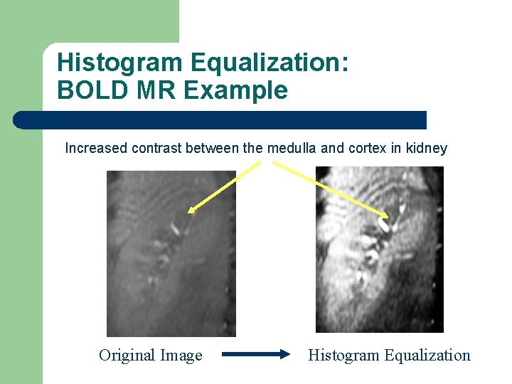 Histogram Equalization: BOLD MR Example Increased contrast between the medulla and cortex in kidney