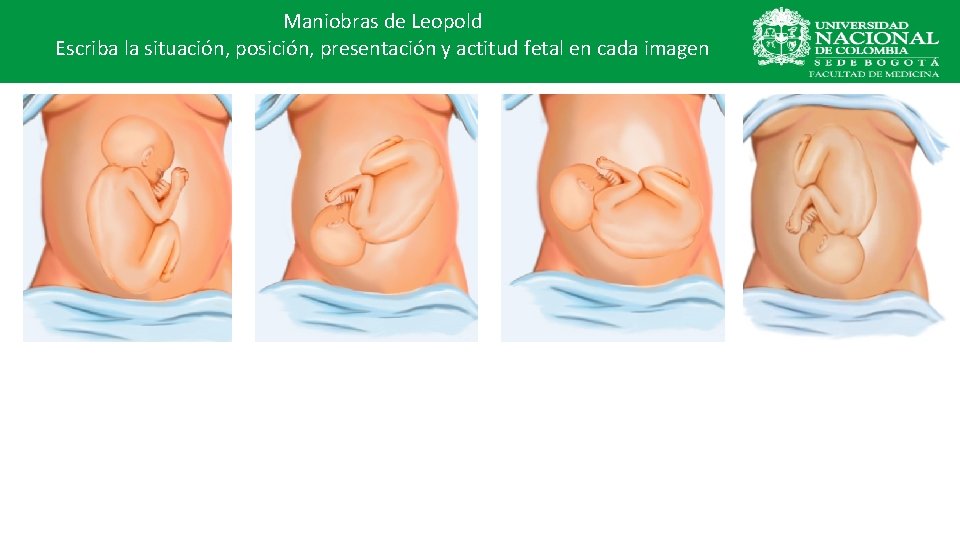 Maniobras de Leopold Escriba la situación, posición, presentación y actitud fetal en cada imagen