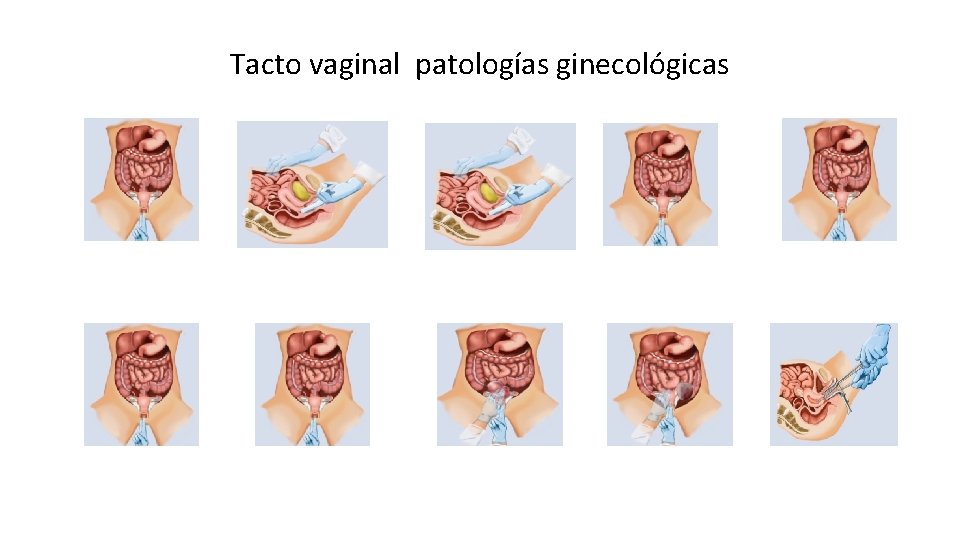 Tacto vaginal patologías ginecológicas 