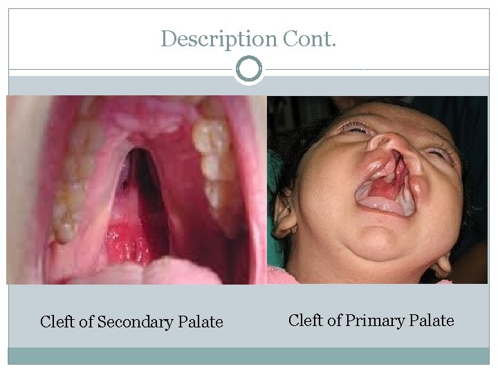 Description Cont. Cleft of Secondary Palate Cleft of Primary Palate 