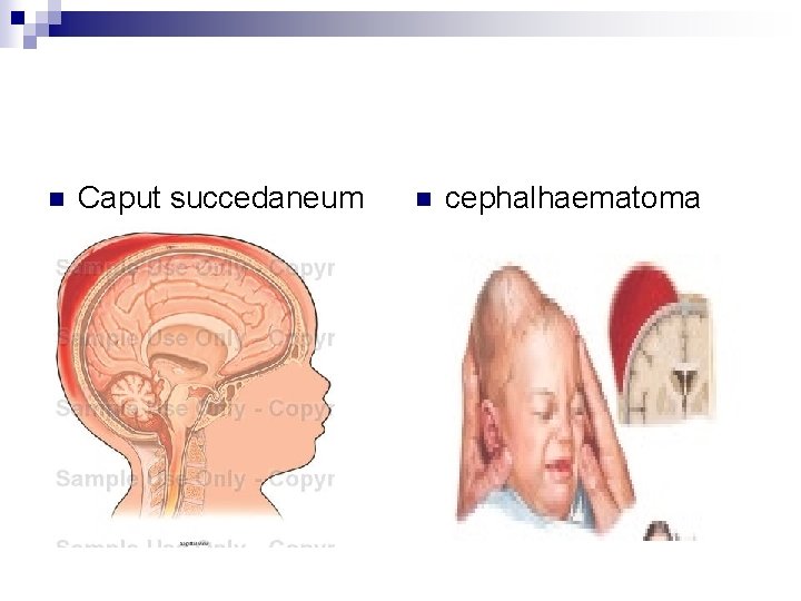 n Caput succedaneum n cephalhaematoma 