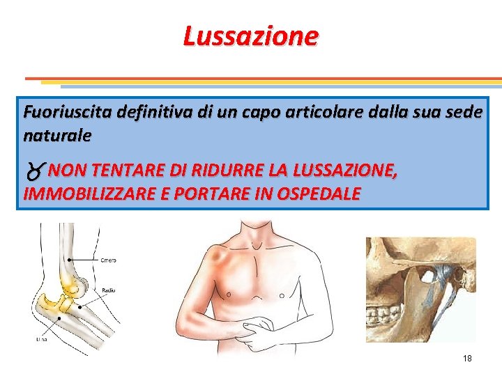 Lussazione Fuoriuscita definitiva di un capo articolare dalla sua sede naturale NON TENTARE DI