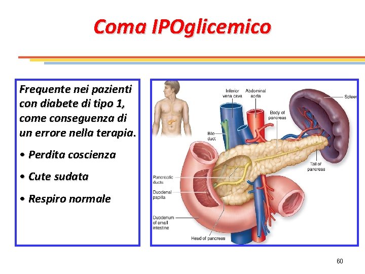 Coma IPOglicemico Frequente nei pazienti con diabete di tipo 1, come conseguenza di un