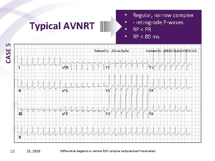 Regular, narrow complex - retrograde P-waves RP < PR RP < 80 ms CASE