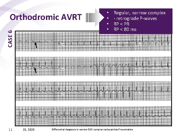 CASE 6 Orthodromic AVRT 11 23, 2020 • • Regular, narrow complex - retrograde