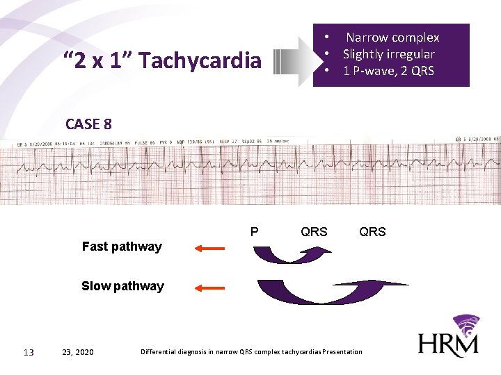 “ 2 x 1” Tachycardia • Narrow complex • Slightly irregular • 1 P-wave,