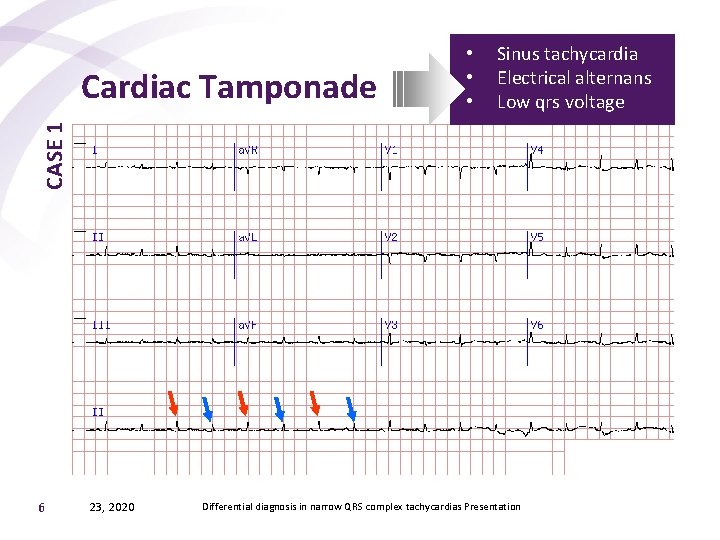 Sinus tachycardia Electrical alternans Low qrs voltage CASE 1 Cardiac Tamponade • • •