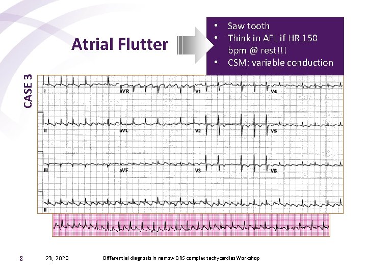 CASE 3 Atrial Flutter • Saw tooth • Think in AFL if HR 150