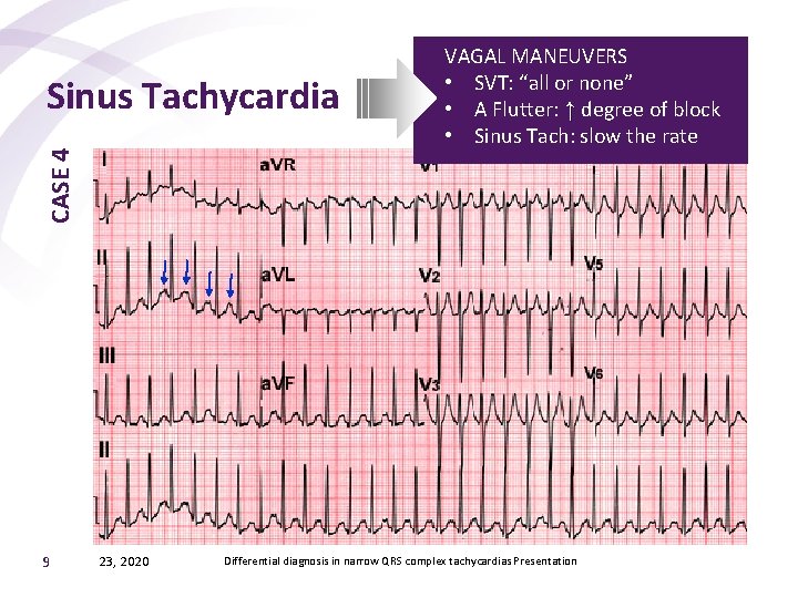 CASE 4 Sinus Tachycardia 9 23, 2020 VAGAL MANEUVERS • SVT: “all or none”