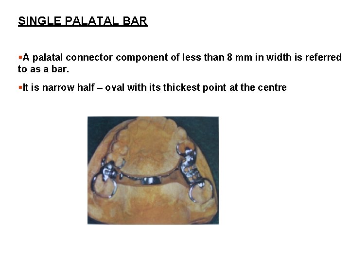 SINGLE PALATAL BAR §A palatal connector component of less than 8 mm in width