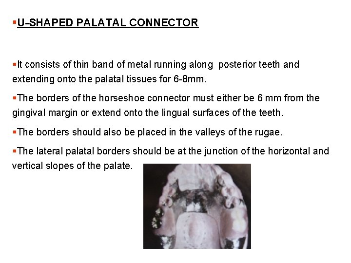 §U-SHAPED PALATAL CONNECTOR §It consists of thin band of metal running along posterior teeth