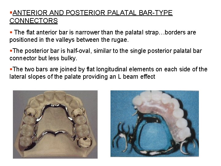 §ANTERIOR AND POSTERIOR PALATAL BAR-TYPE CONNECTORS § The flat anterior bar is narrower than