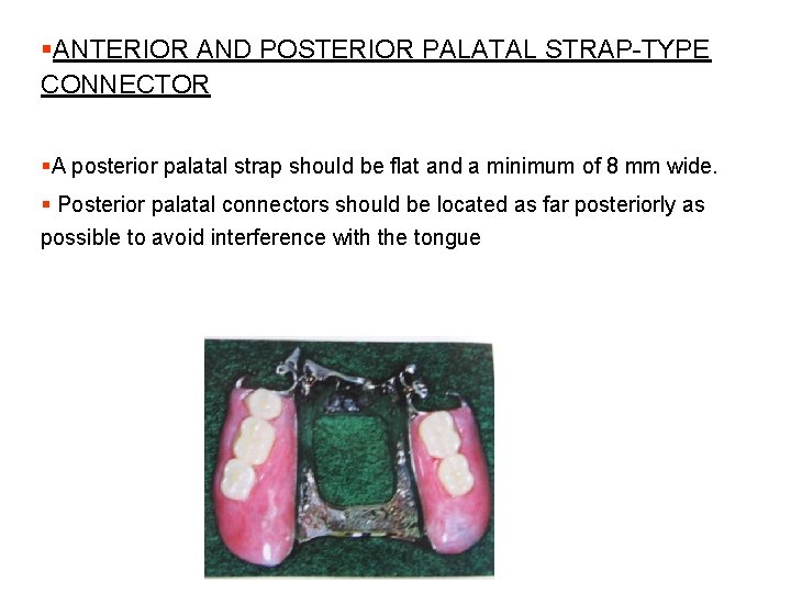§ANTERIOR AND POSTERIOR PALATAL STRAP-TYPE CONNECTOR §A posterior palatal strap should be flat and