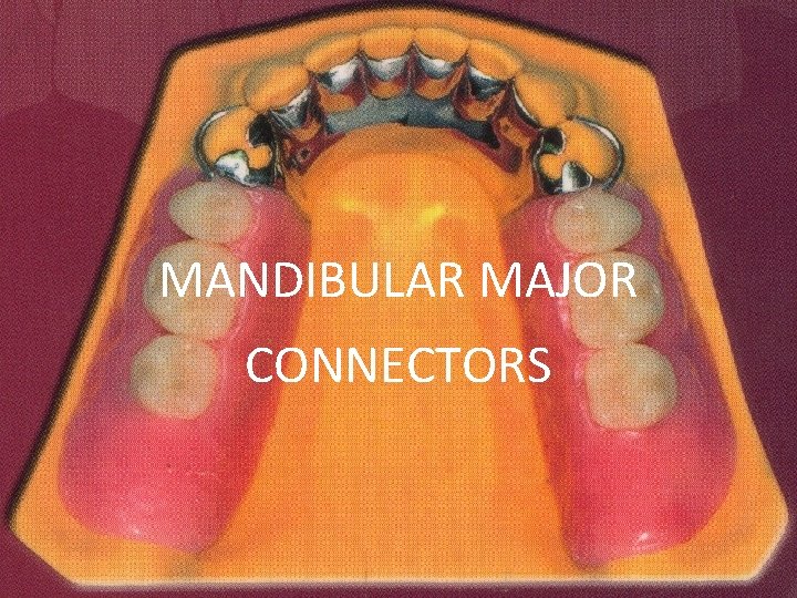 MANDIBULAR MAJOR CONNECTORS 