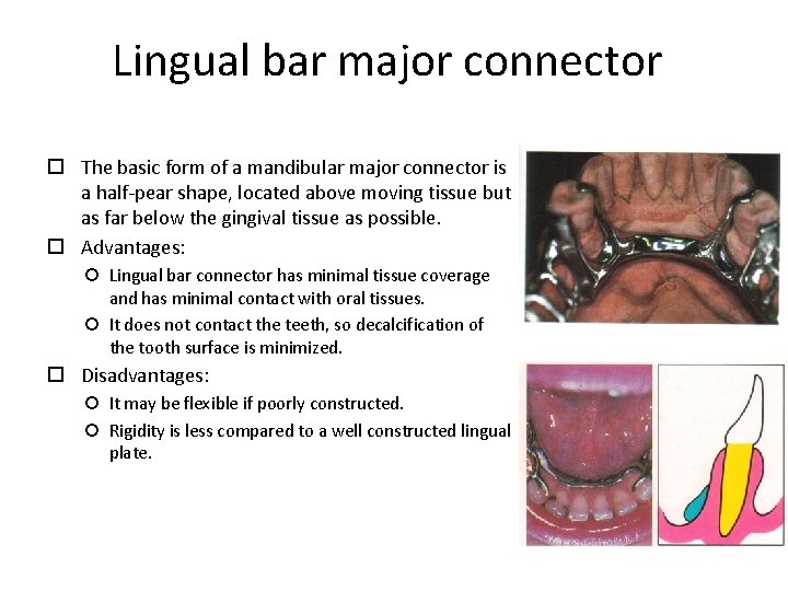 Lingual bar major connector The basic form of a mandibular major connector is a