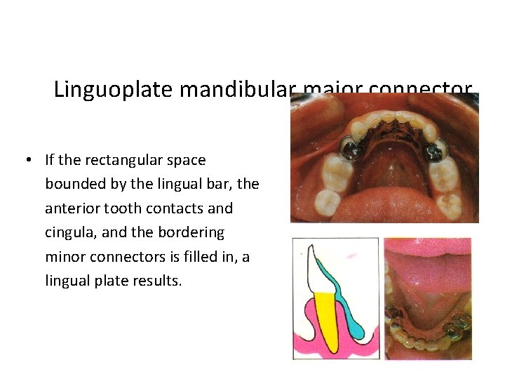 Linguoplate mandibular major connector • If the rectangular space bounded by the lingual bar,