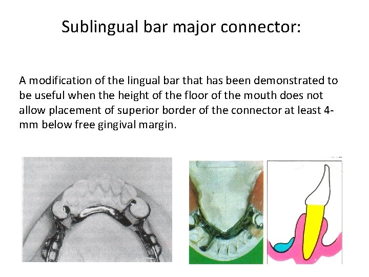 Sublingual bar major connector: A modification of the lingual bar that has been demonstrated
