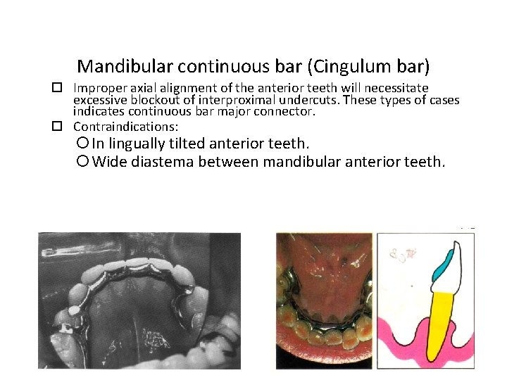 Mandibular continuous bar (Cingulum bar) Improper axial alignment of the anterior teeth will necessitate