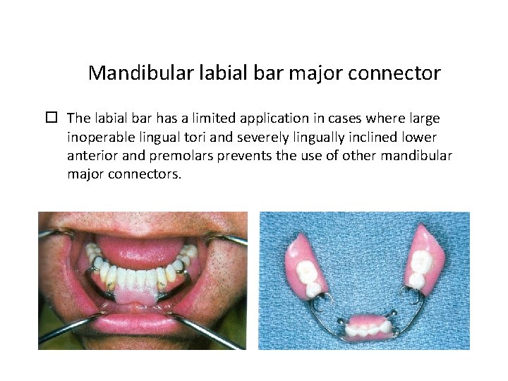 Mandibular labial bar major connector The labial bar has a limited application in cases