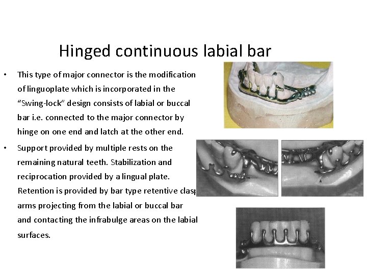 Hinged continuous labial bar • This type of major connector is the modification of