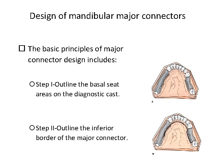 Design of mandibular major connectors The basic principles of major connector design includes: Step
