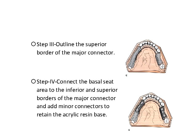  Step III-Outline the superior border of the major connector. Step-IV-Connect the basal seat