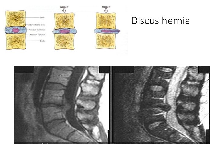 Discus hernia 