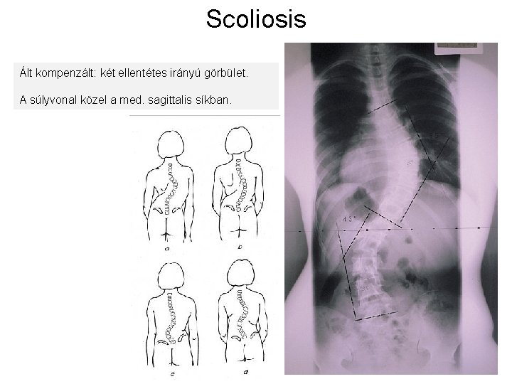 Scoliosis Ált kompenzált: két ellentétes irányú görbület. A súlyvonal közel a med. sagittalis síkban.