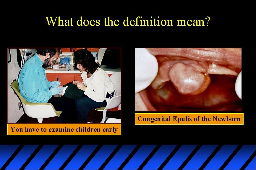 What does the definition mean? Congenital Epulis of the Newborn You have to examine